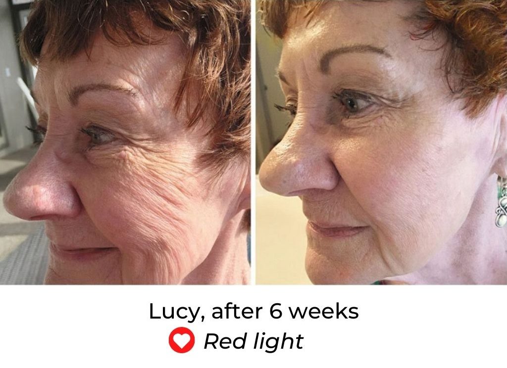 LED Face Mask Before and After