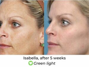 LED Face Mask Before and After