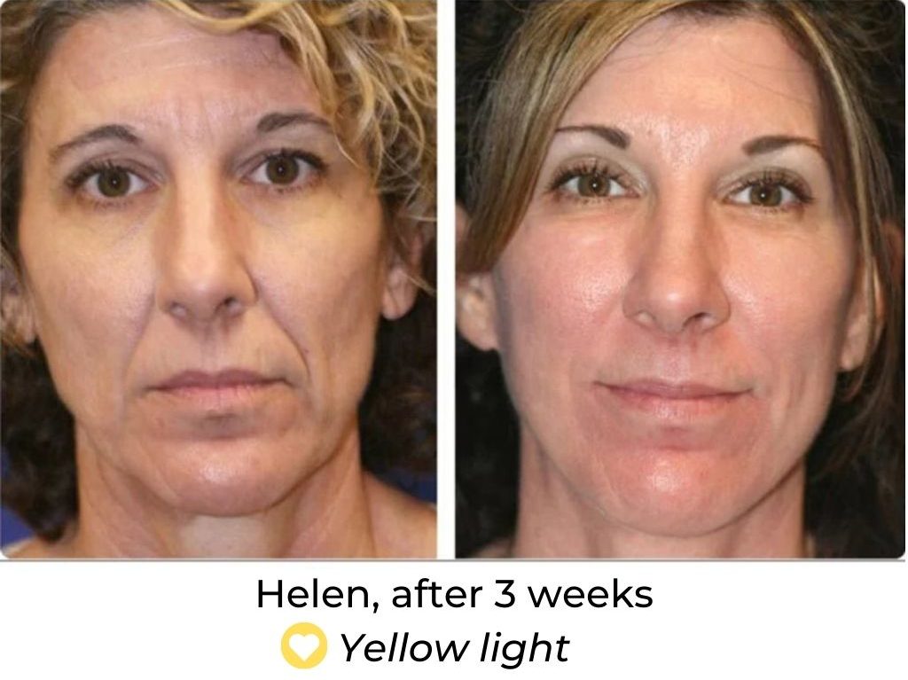 solas led face mask review before and after wrinkles