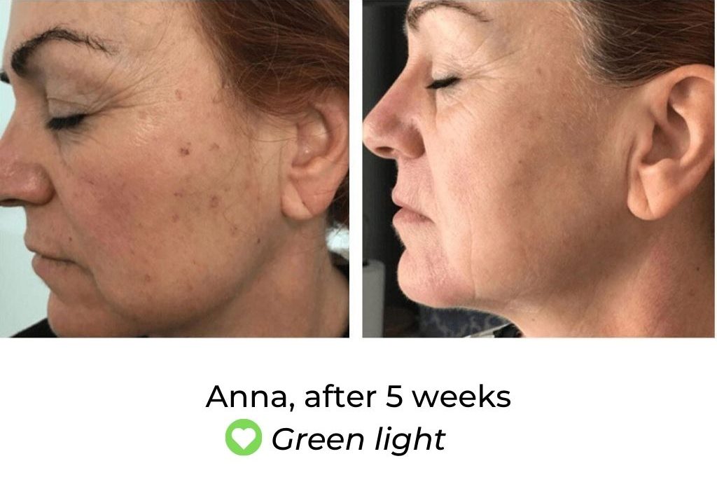 LED Face Mask Before and After
