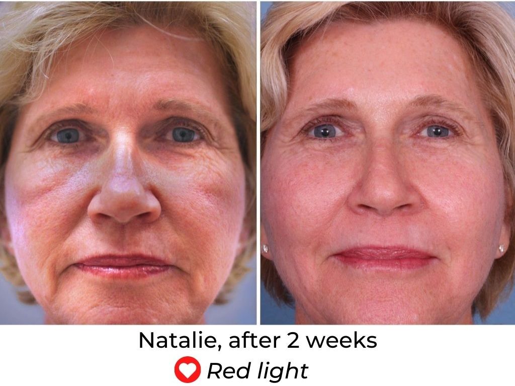 LED Face Mask Before and After