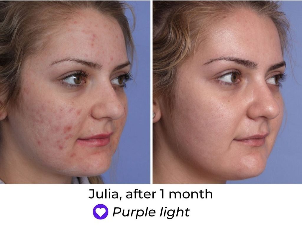 LED Face Mask Before and After
