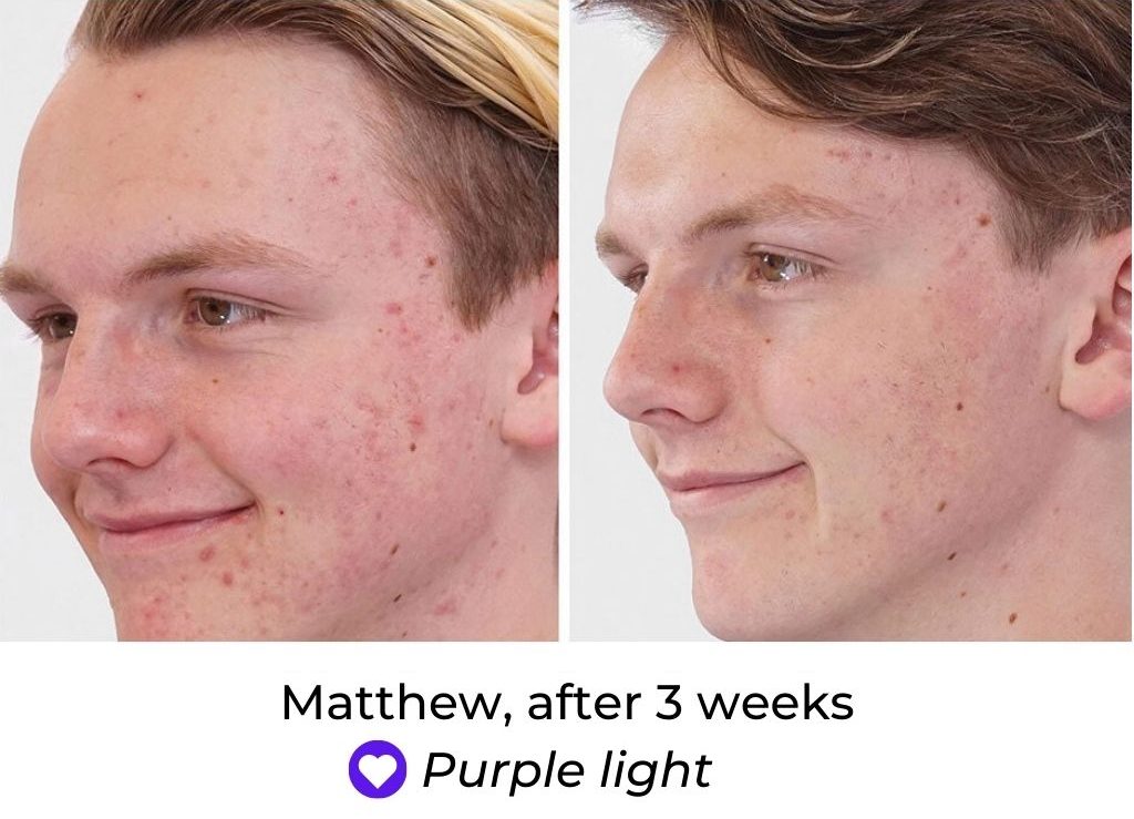 LED Face Mask Before and After