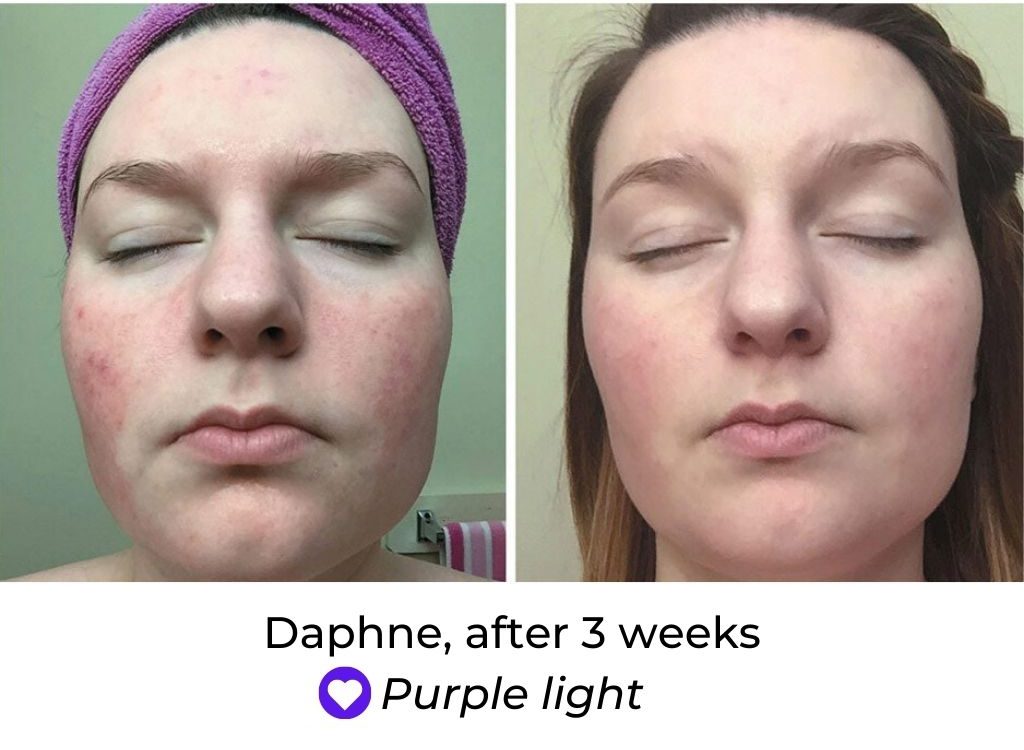 LED Face Mask Before and After