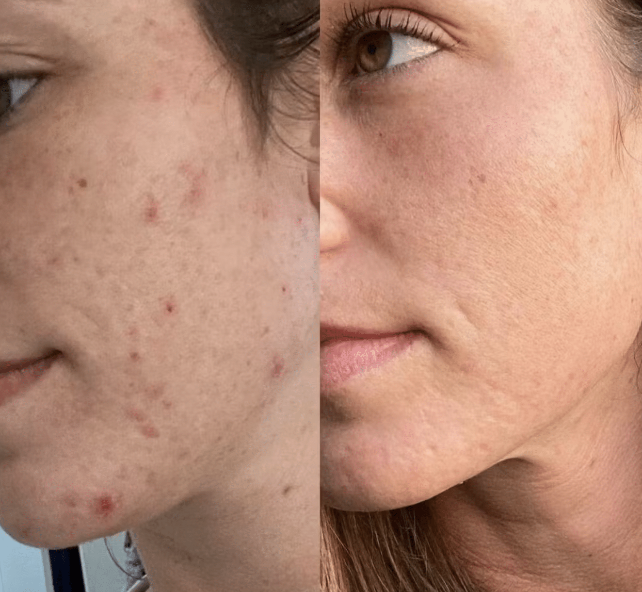 Cleopatra LED Mask Results – Before and After