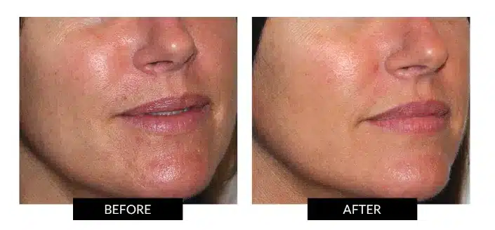 Mask & Glo 7.0 Before and After Results
