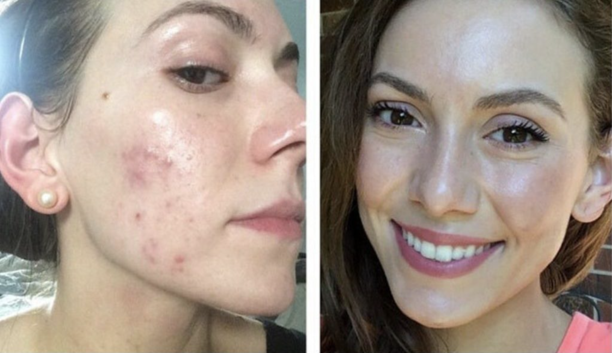 DermaLight LED Mask Results – Before and After