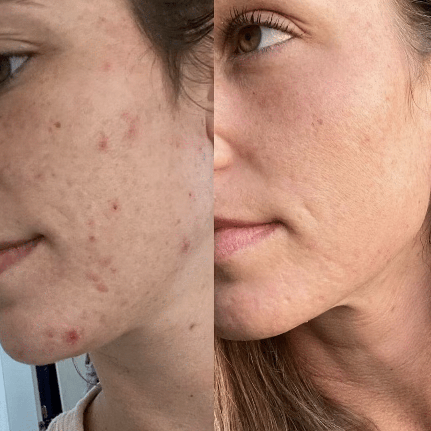 Evertone LED Mask Before and After Results