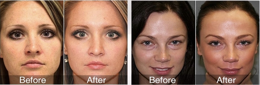 Cleopatra LED Mask results after a month