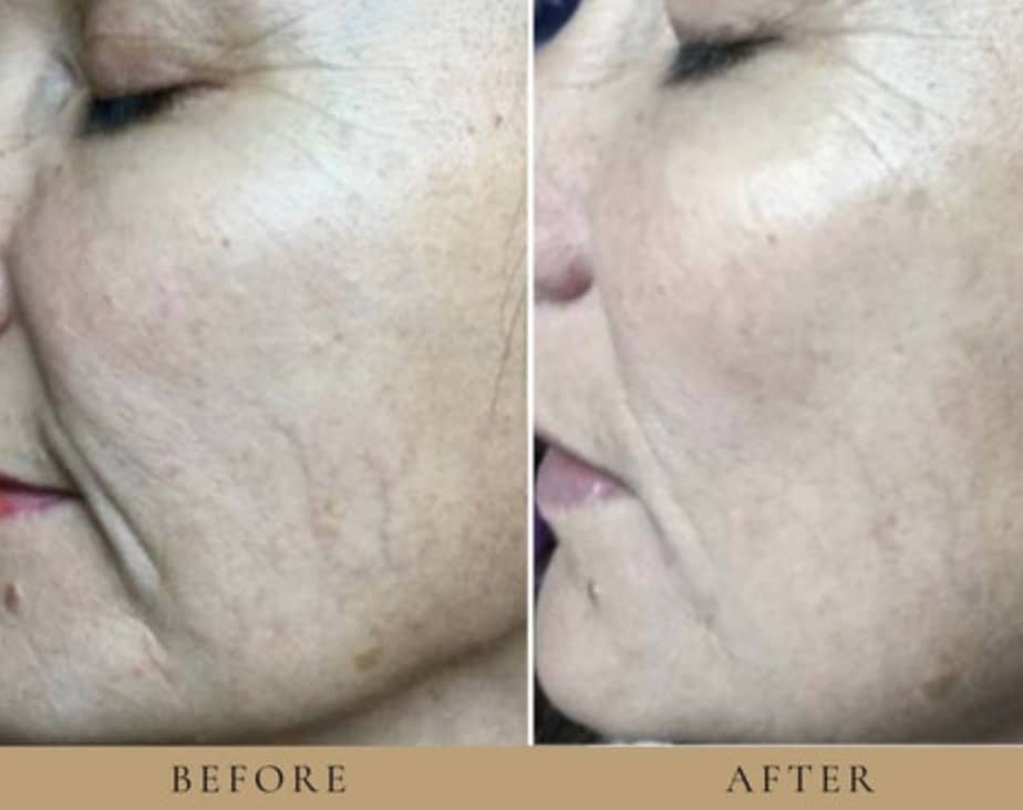 Red Light Therapy For Wrinkles Before & After